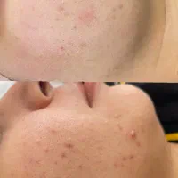 فیشیال تخصصی و درمانی پوست|خدمات آرایشگری و زیبایی|آمل, |دیوار