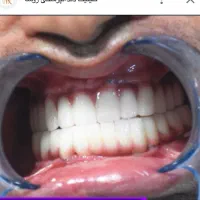 مرکزفوق تخصصی ایمپلنت دیجیتال/فوری/سبک کاخ لبخند
