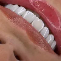 کامپوزیت دندان