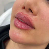 تزریقات زیبایی و درمانی