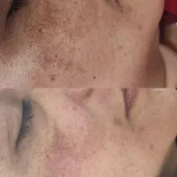 رفع کک و مک و لک . خال . اسکین تگ در یک جلسه|خدمات آرایشگری و زیبایی|بیرجند, |دیوار