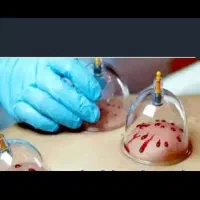 حجامت بهاره