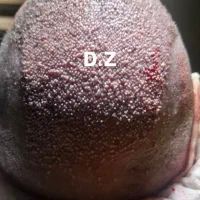 کاشت مو فول تراکم شیرازی در ساری