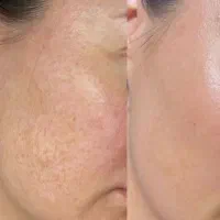 درمان لک جای زخم آکنه استرچ مارک و خالبرداری