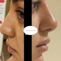 ترریق ژل و بوتاکس|خدمات آرایشگری و زیبایی|اصفهان, کوی شهید کشوری|دیوار