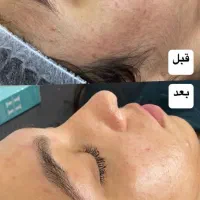 درماپلنینگ (پاکسازی شیوتخصصی صورت)350به مدته محدود|خدمات آرایشگری و زیبایی|محمدشهر, ولدآباد|دیوار