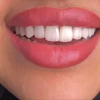 دندان ، دندانپزشکی ، لمینت ، کامپوزیت ، ایمپلنت|خدمات آرایشگری و زیبایی|مشهد, دانشجو|دیوار