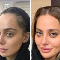 مدل رایگان برای تزریق ژل فیلر و بوتاکس