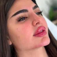 تزریق ژل لب و گونه و چانه.. (جشنواره)درمطب فقط499ت|خدمات آرایشگری و زیبایی|اصفهان, باغ زیار|دیوار