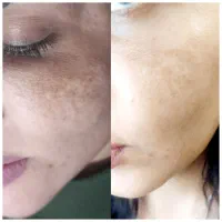 آموزش وخدمات فشیال پوست|خدمات آرایشگری و زیبایی|مبارکه, |دیوار