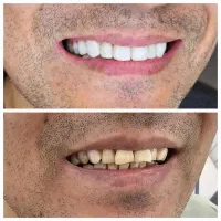 دندانپزشکی کامپوزیت لمینیت بلیچینگ عصب کشی ترمیم