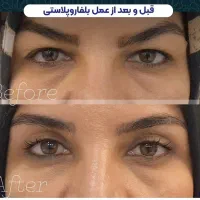 جراحی بلفاروپلاستی(رفع افتادگی پلک)بوکال فت/ساکشن|خدمات آرایشگری و زیبایی|تهران, هفت حوض|دیوار