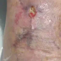 کارشناس زخم پانسمان نوین درمان در منزل