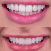 ایمپلنت،بلیچینگ،زیبایی دندان،انواع خدمات درمانی،