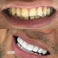 کامپوزیت دندان عصب کشی روکش|خدمات آرایشگری و زیبایی|کرج, باغستان|دیوار