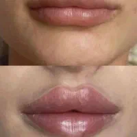 ژل لب گونه چونه زاویه خدمات پرسینگ|خدمات آرایشگری و زیبایی|صدرا-فارس, فاز ۱|دیوار