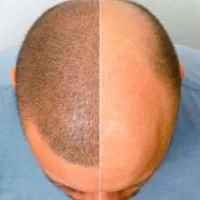 دستیار کاشت مو