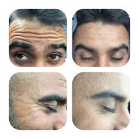 تخفیف بوتاکس،ژل لب،پی ار پی فقط تا فردا(۱ آبان)|خدمات آرایشگری و زیبایی|یاسوج, |دیوار