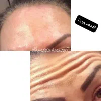تزریق ژل و بوتاکس|خدمات آرایشگری و زیبایی|بابل, |دیوار
