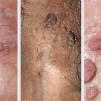 درمان HPV اچ پی وی