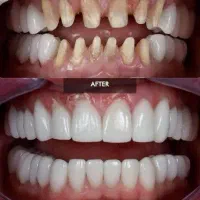 دندانپزشکی صدف (با شرایط اقساط) کامپوزیت|خدمات آرایشگری و زیبایی|قم, حقیقت|دیوار