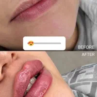 تزریق‌ ژل و لیفت نخ و مروژل جوانساز