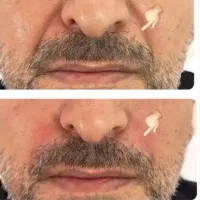 جشنواره ی پاییزه ی فیلر وبوتاکس|خدمات آرایشگری و زیبایی|ارومیه, |دیوار