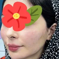 ژل سی سی۵۰۰ پرسینگ، چال گونه|خدمات آرایشگری و زیبایی|اهواز, کمپلو جنوبی|دیوار