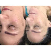 پاکسازی رایگان پوست مطهری|خدمات آرایشگری و زیبایی|رشت, خمیران زاهدان|دیوار