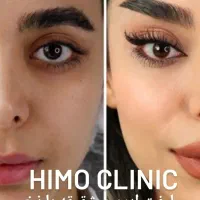 بوتاکس فیلر نخ هایفوتراپی توسط پزشک زیبایی