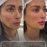 جوانسازی و لیفت بدون جراحی|خدمات آرایشگری و زیبایی|تهران, اختیاریه|دیوار