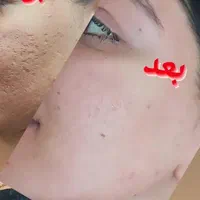 تخفیف خدمات درمان تخصصی پوست.فشیال پاکسازی جوانساز|خدمات آرایشگری و زیبایی|میاندوآب, |دیوار