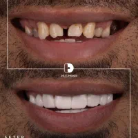 کامپوزیت دندان/لمینیت/دندانپزشکی|خدمات آرایشگری و زیبایی|مشهد, کوثر|دیوار