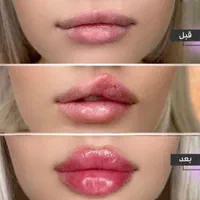 ژل و بوتاکس فشیال،پی آر پی مو زانو صورت،لیزر مو|خدمات آرایشگری و زیبایی|کرج, گوهردشت|دیوار