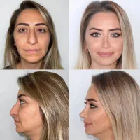 عمل جراحی بینی فقط 50 با طراحی چهره|خدمات زیبایی و سلامت|کرج, کوی مدرس|دیوار