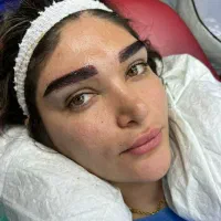 کاشت مو میکرو کاشت ابرو