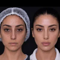 فرصت ویژه ( لیفت صورت ، ابرو، غبغب)