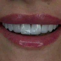 کامپوزیت.لمینت|خدمات آرایشگری و زیبایی|تهران, هفت حوض|دیوار