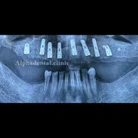 جشنواره ایمپلنت دندان به مدت محدود/دندانپزشکی|خدمات آرایشگری و زیبایی|تهران, خزانه|دیوار