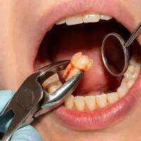 کشیدن دندان اصولی و ارزان