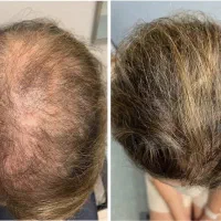 اگه این نشونه رو داری، برای کاشت دست نگه دار