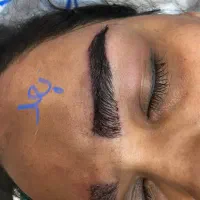 کاشت ابرو بدون جراحی تکنیک و بدون دوره ی نقاهت