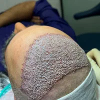 کاشت مو با قیمت استثنایی