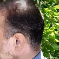 پوست چرب و جای جوش و آکنه