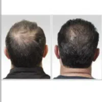 خدمات پی آر پی(PRP)پوست و مو و مزوتراپی اگزوزوم