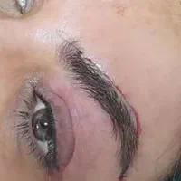 بلفاروپلاستی لیفت ابرو غبغب کاشت جراحی پلک