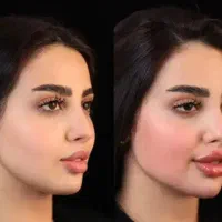 ژل و بوتاکس مزو پی آر پی  ژل توسط پزشک