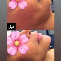 تخفیفات خدمات فیلر و بوتاکس کلینیک|خدمات آرایشگری و زیبایی|شاهین‌شهر, فردوسی|دیوار
