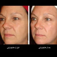 هایفوتراپی صورت و غبغب و شکم|خدمات آرایشگری و زیبایی|تبریز, |دیوار