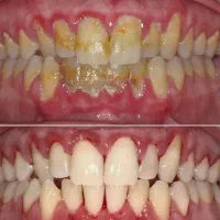 جرمگیری و بروساژ دندان 1.480